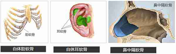 10个你最关心的隆鼻问答