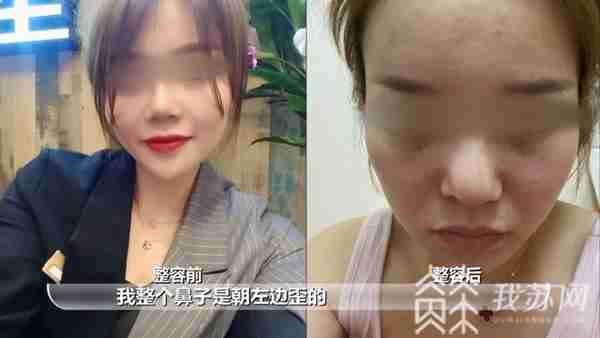 女子整形后鼻子歪了 院方：肋骨还有，可以修复！|解忧帮