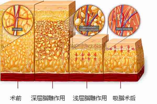 吸脂手术多久可以恢复？