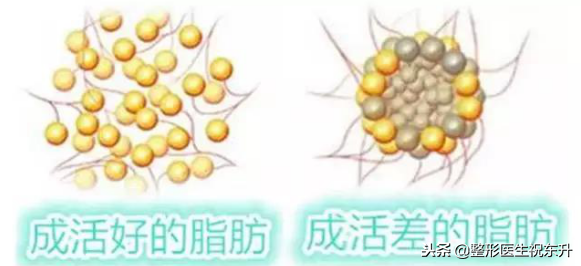 自体脂肪被称为“软黄金”，不过填充的风险也不少