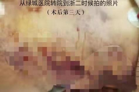 抽脂手术失败后，患者的身体会发生什么变化？抽脂手术有多可怕？