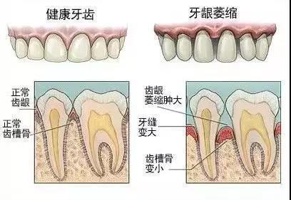 患者咨询丨医生，我牙缝大怎么办？